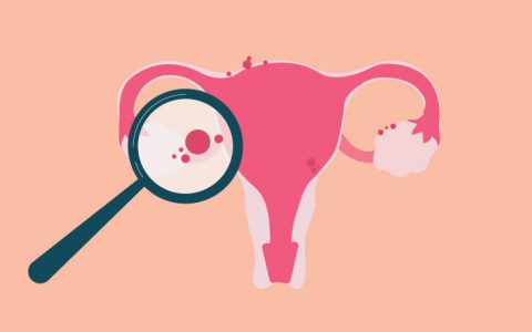 Endometriose: o que é esta doença crónica associada à infertilidade?