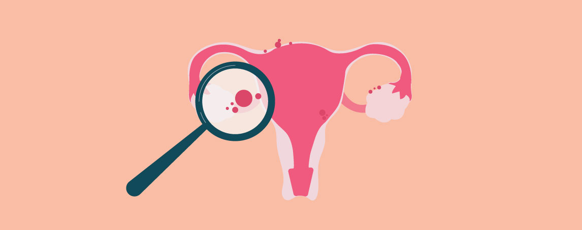 Endometriose: o que é esta doença crónica associada à infertilidade?